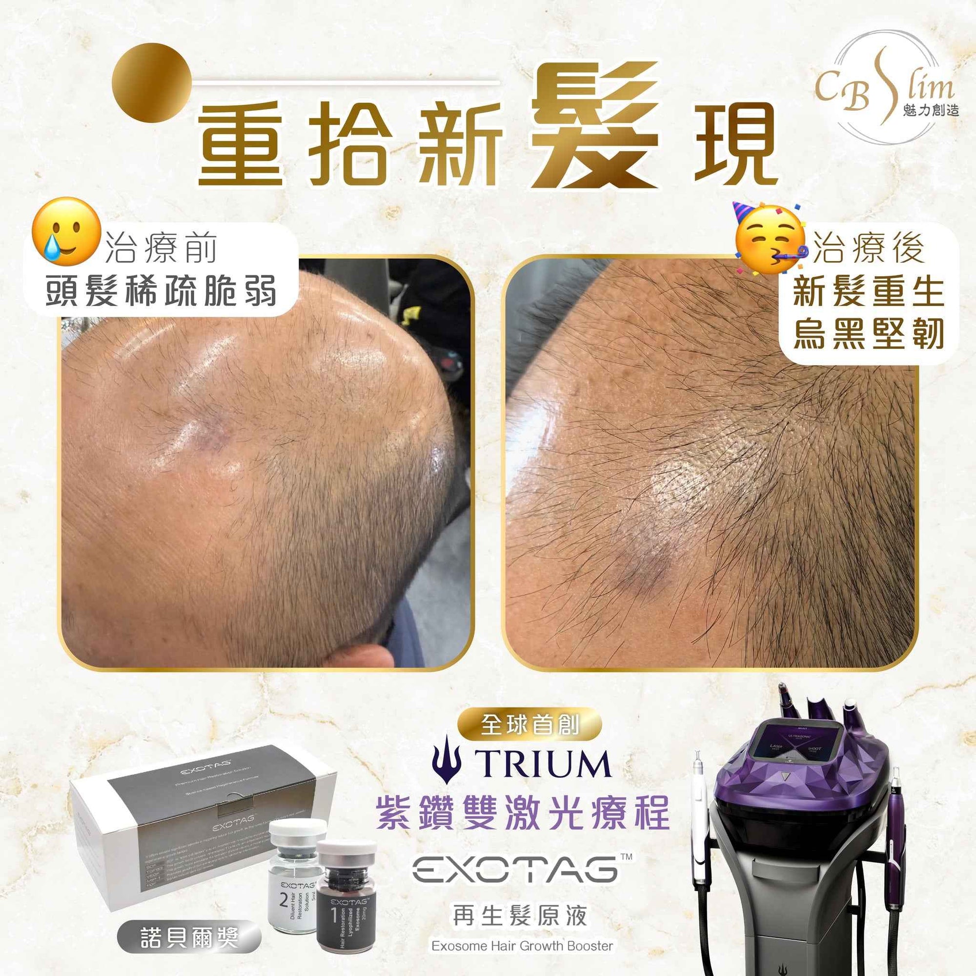 TRIUM紫鑽雙激光增髮治療